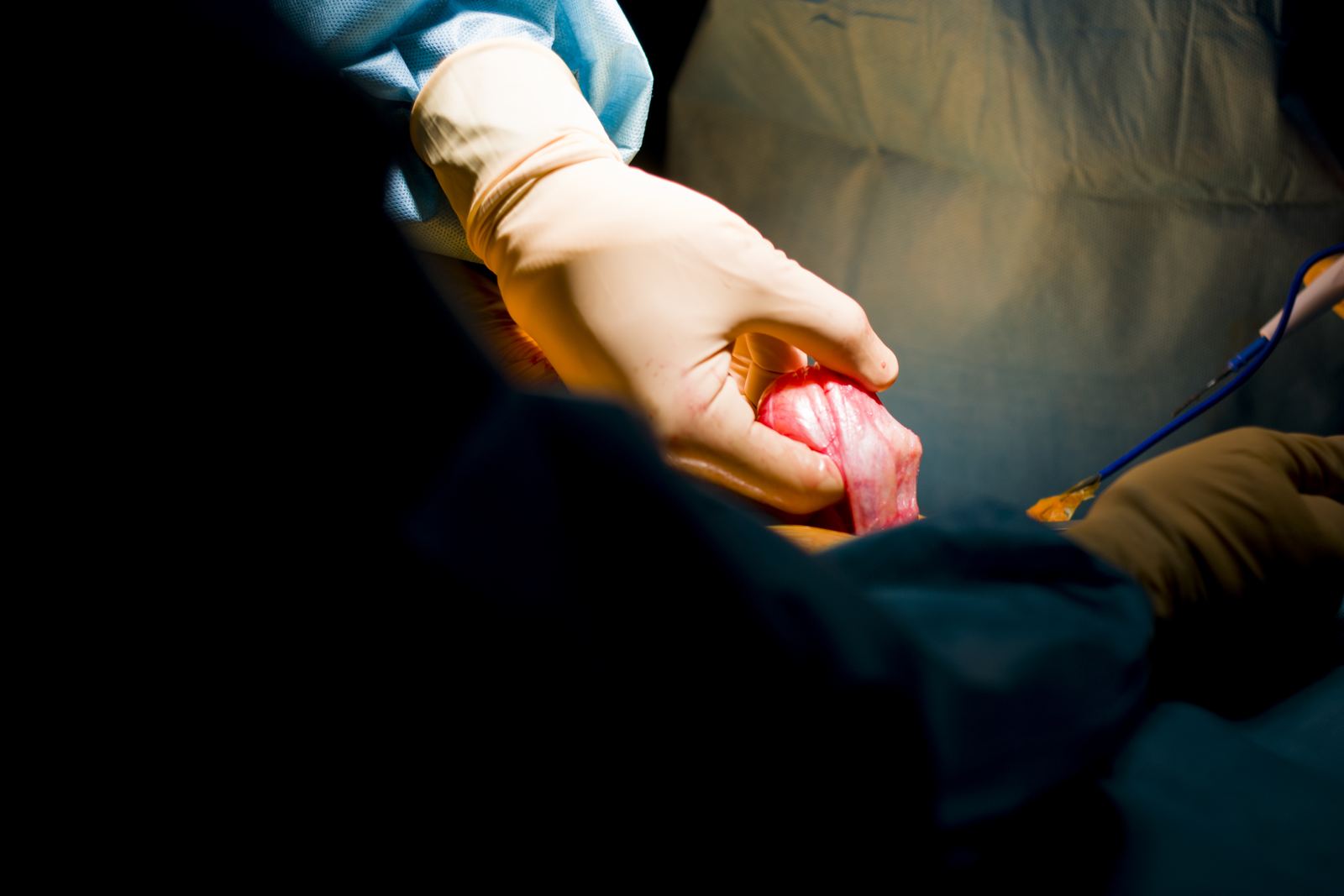 Sac herniaire tenu par la main gantée du chirurgien lors d'une cure de hernie de l'aine par laparoscopie avec pose d'une prothèse